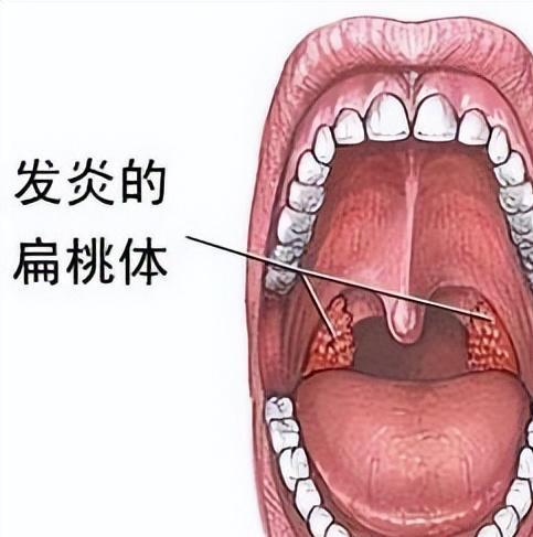 扁桃体炎图片,图片揭示的咽喉炎症真相