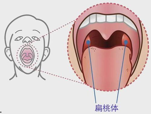 扁桃体炎图片,图片揭示的咽喉炎症真相