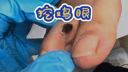 鸡眼视频,视频深度解析