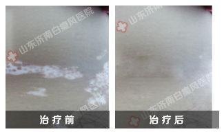 身上有小白点图片,探寻健康与美丽之道
