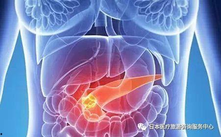 日本胰腺癌,日本研究揭示的发病机制与防治策略