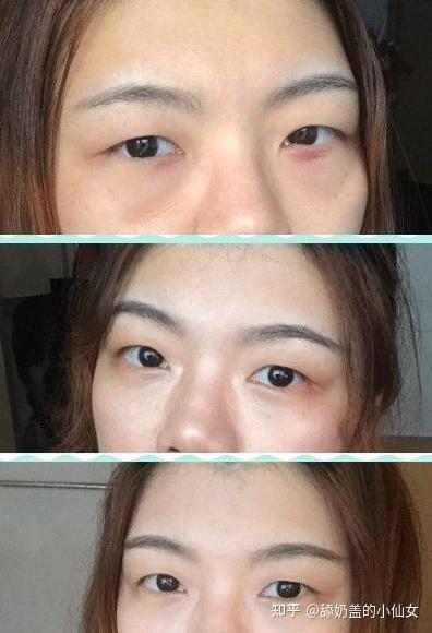 去除眼袋手术视频,专业视频带你直观了解