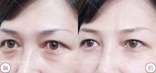 去除眼袋手术视频,专业视频带你直观了解