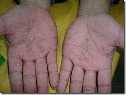 热疹症状图片,识别与预防