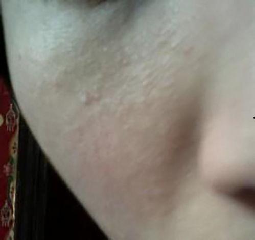 热疹症状图片,识别与预防