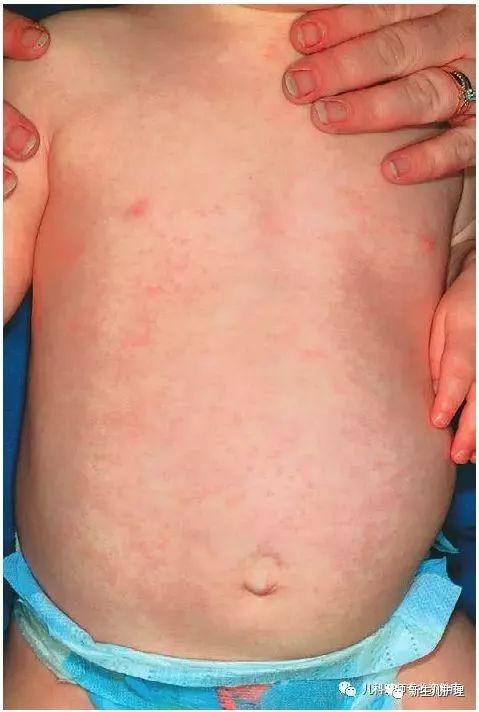 热疹症状图片,识别与预防