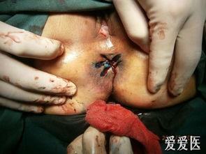 混合痔术后水肿图片,混合痔术后水肿症状与护理要点解析