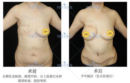 混合痔术后水肿图片,混合痔术后水肿症状与护理要点解析