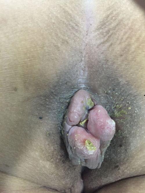 混合痔术后水肿图片,混合痔术后水肿症状与护理要点解析